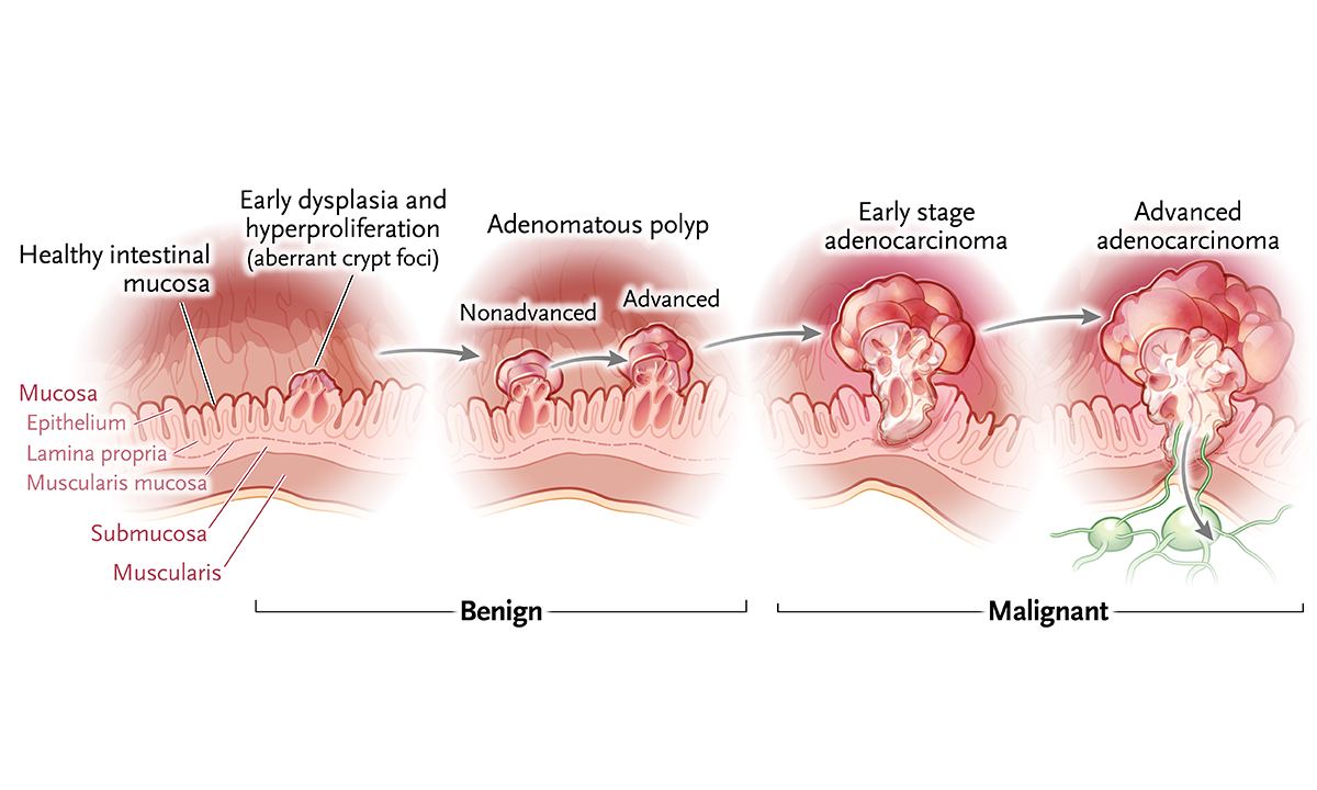 Advancing Colorectal Polyp Detection in Colonoscopy Through Region-Guided Deep Learning